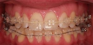 Clear conventional braces