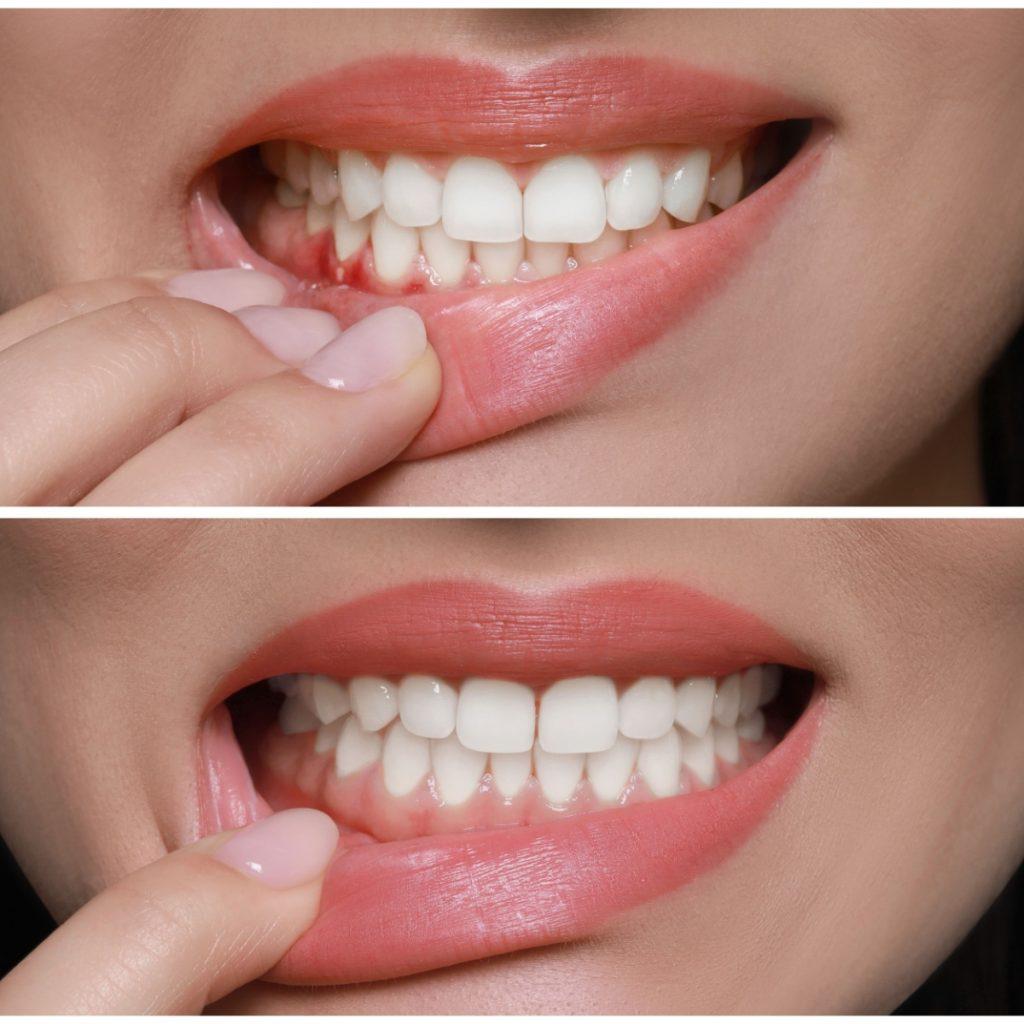 gum disease fb