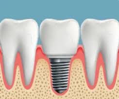 dental implant
